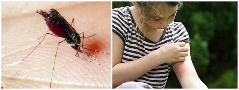 Nodurile dureroase după o mușcătură de țânțar pot fi un simptom al dirofilarei